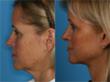 Body Oasis Laser Aesthetics Acquires Accusculpt Laser Assisted...
